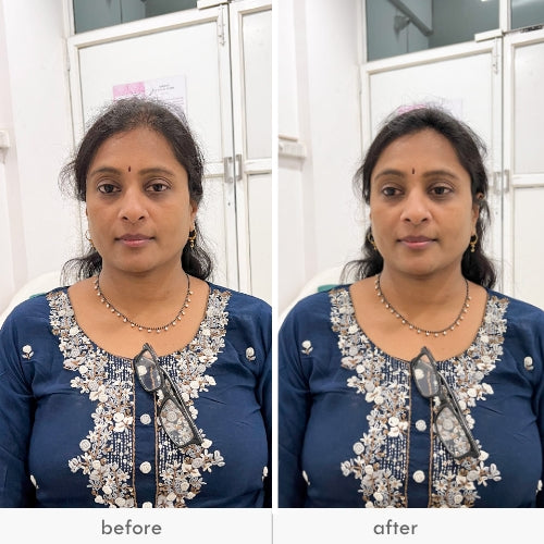 Front Hair Extensions Invisible CoverUp patch 1 Hair Stop India